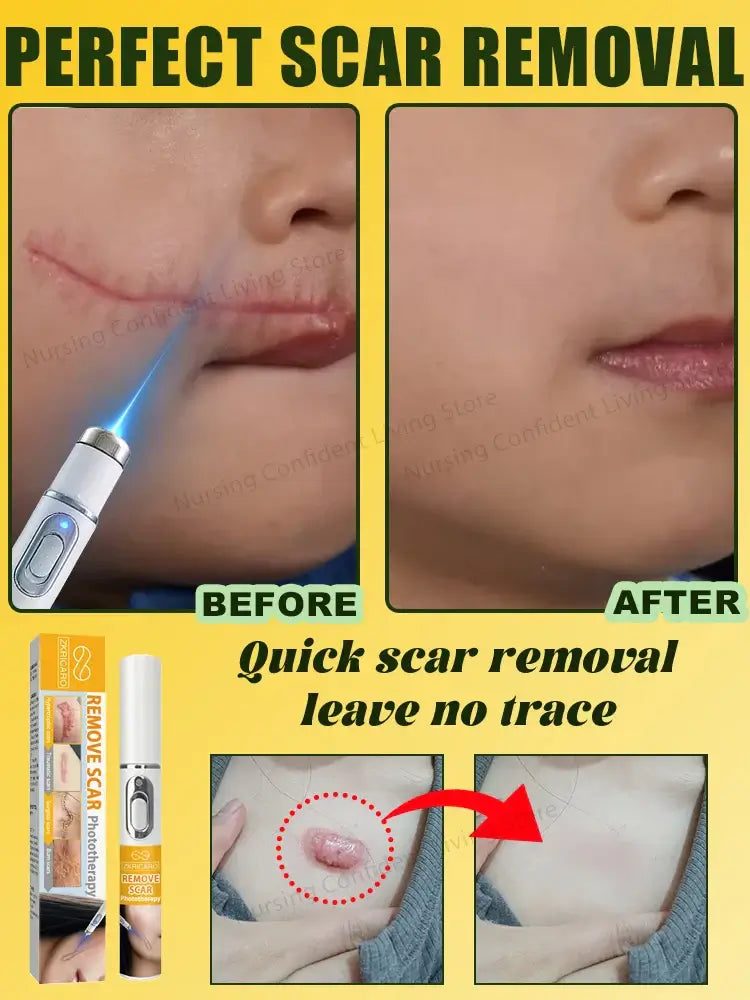 Laser Scar Removal Brush – Fast & Non-Electric Skin Rejuvenation Tool